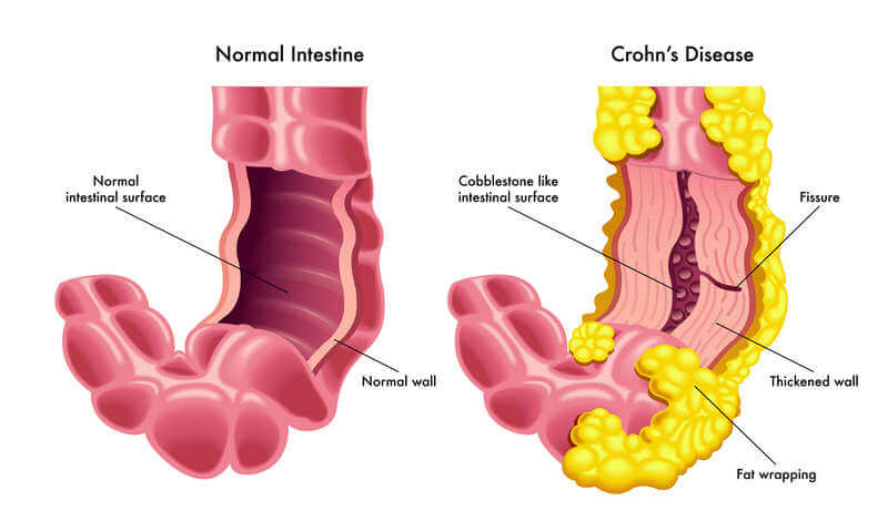 Signs of Crohn's disease
